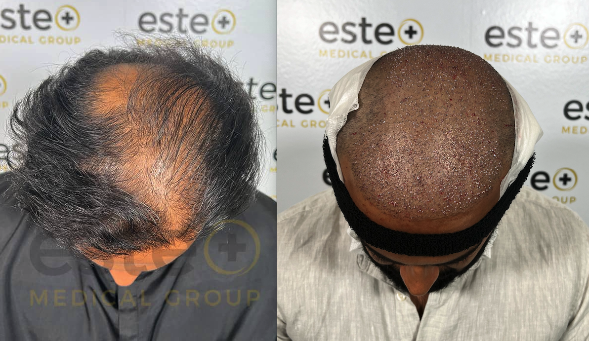 10Days After Hair Transplant, Rishab Shares Successful Results!